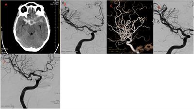 Early Treatment of Ruptured Blood Blister-Like Aneurysms of the Internal Carotid Artery With Flow Diverters Using Single Antiplatelet Therapy: A Single-Center Experience With Long-Term Follow-Up